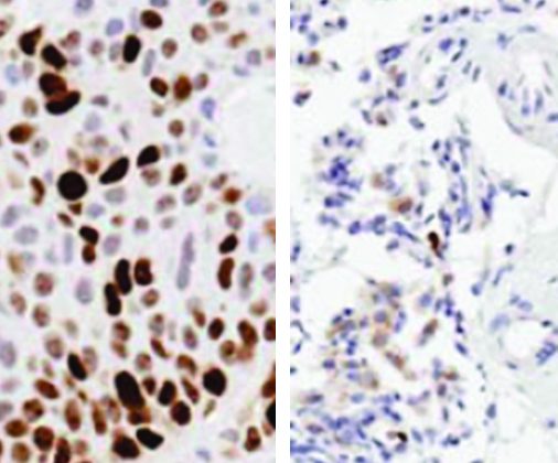 Two different images of tumor growth reduction; significantly more brown staining is on the left.